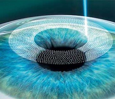 sadighi ophtalmologue service Femto-Lasik