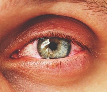 sadighi ophtalmologue service GLAUCOME