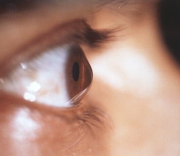 sadighi ophtalmologue service KERATOCONE