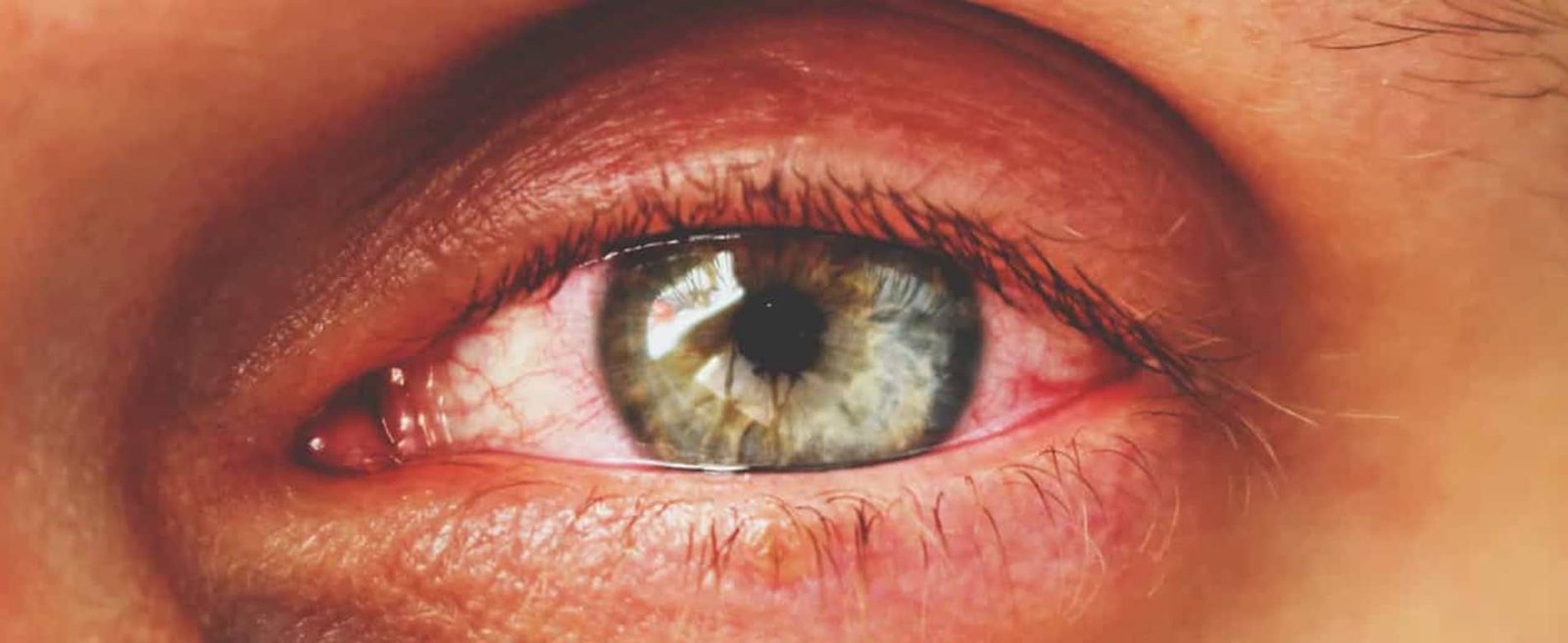 Sadighi ophtalmologue Glaucome