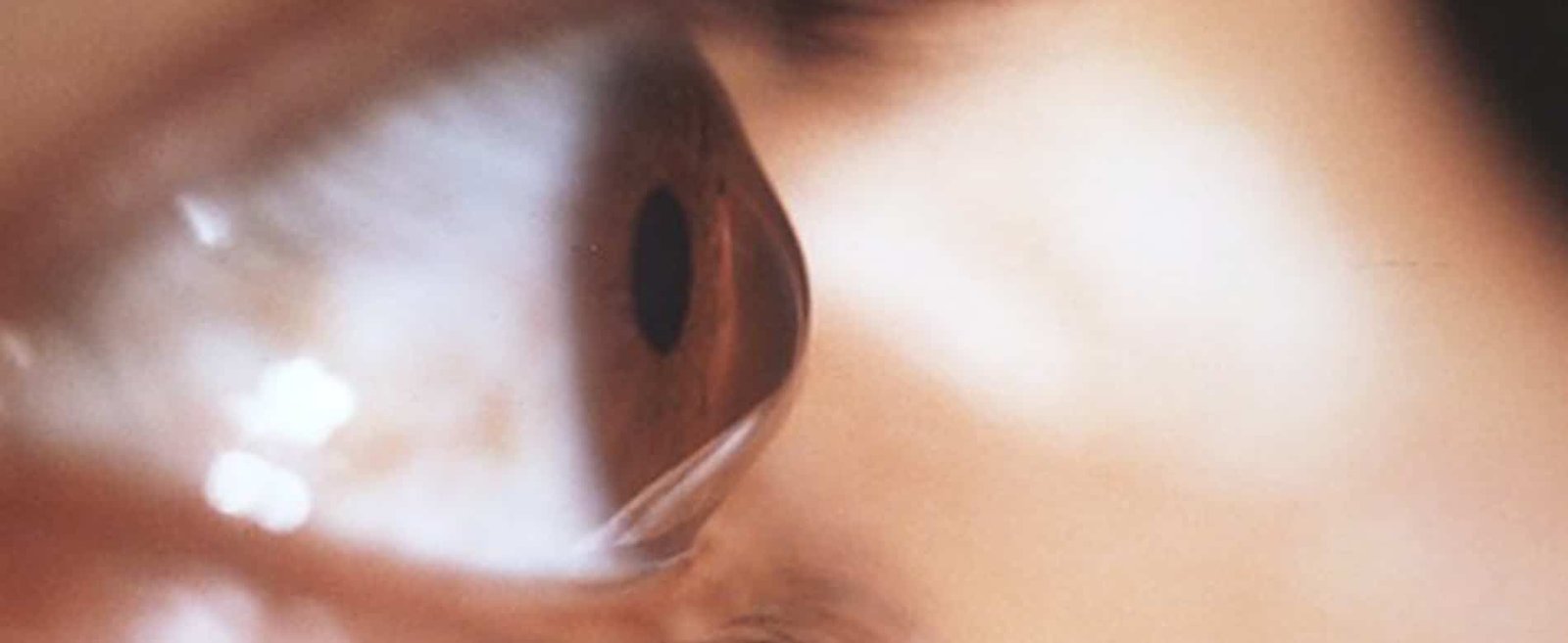 Sadighi ophtalmologue Kératocône