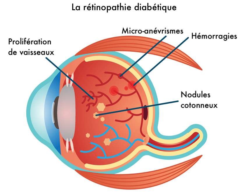 retinopathie-diabétique-casablanca-maroc-sadighi-ophtalmo